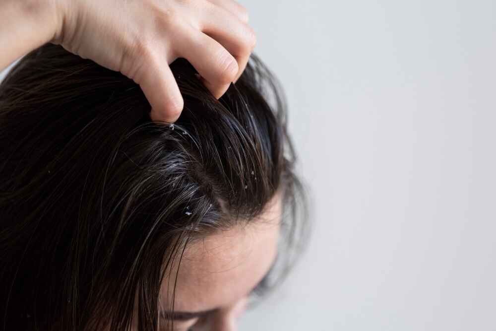 10 Best Home Remedies to Cure Dandruff Naturally at Home