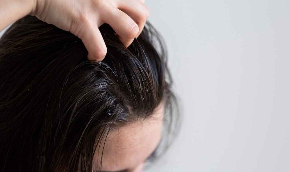 10 Best Home Remedies to Cure Dandruff Naturally at Home