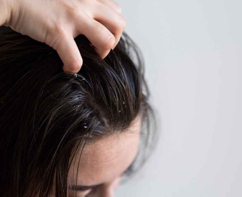 10 Best Home Remedies to Cure Dandruff Naturally at Home